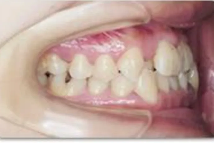 拡大装置を使った非抜歯の症例-Before